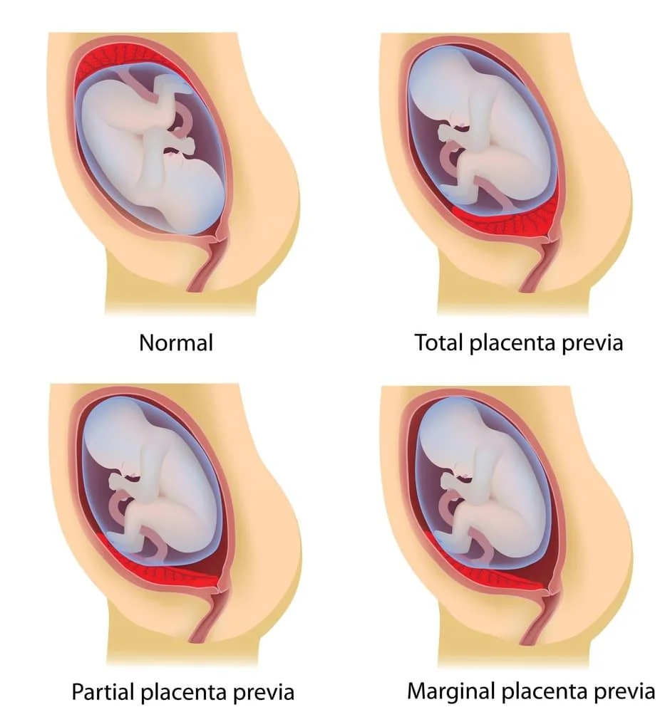 Placenta praevia: cauze, simptome, tratament