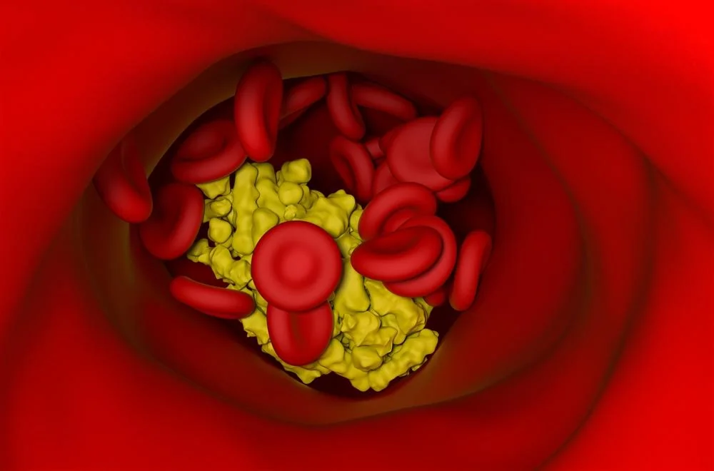 Hipercolesterolemie (colesterol mare): cauze, simptome, tratament