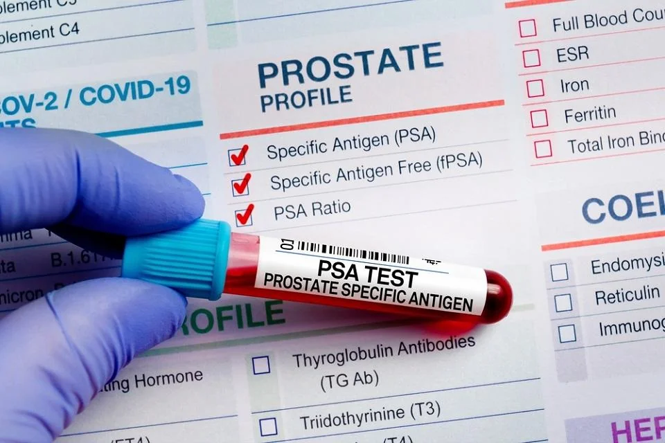 PSA (Antigenul Specific Prostatic): ce este, valori, afectiuni asociate