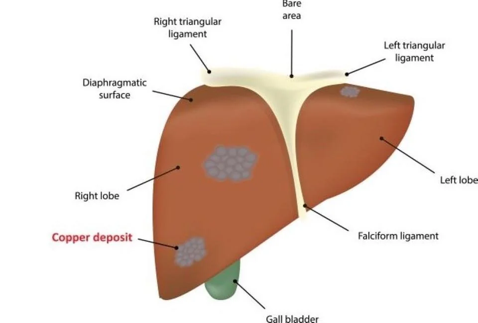 Boala Wilson: Cauze, manifestari si optiuni de tratament