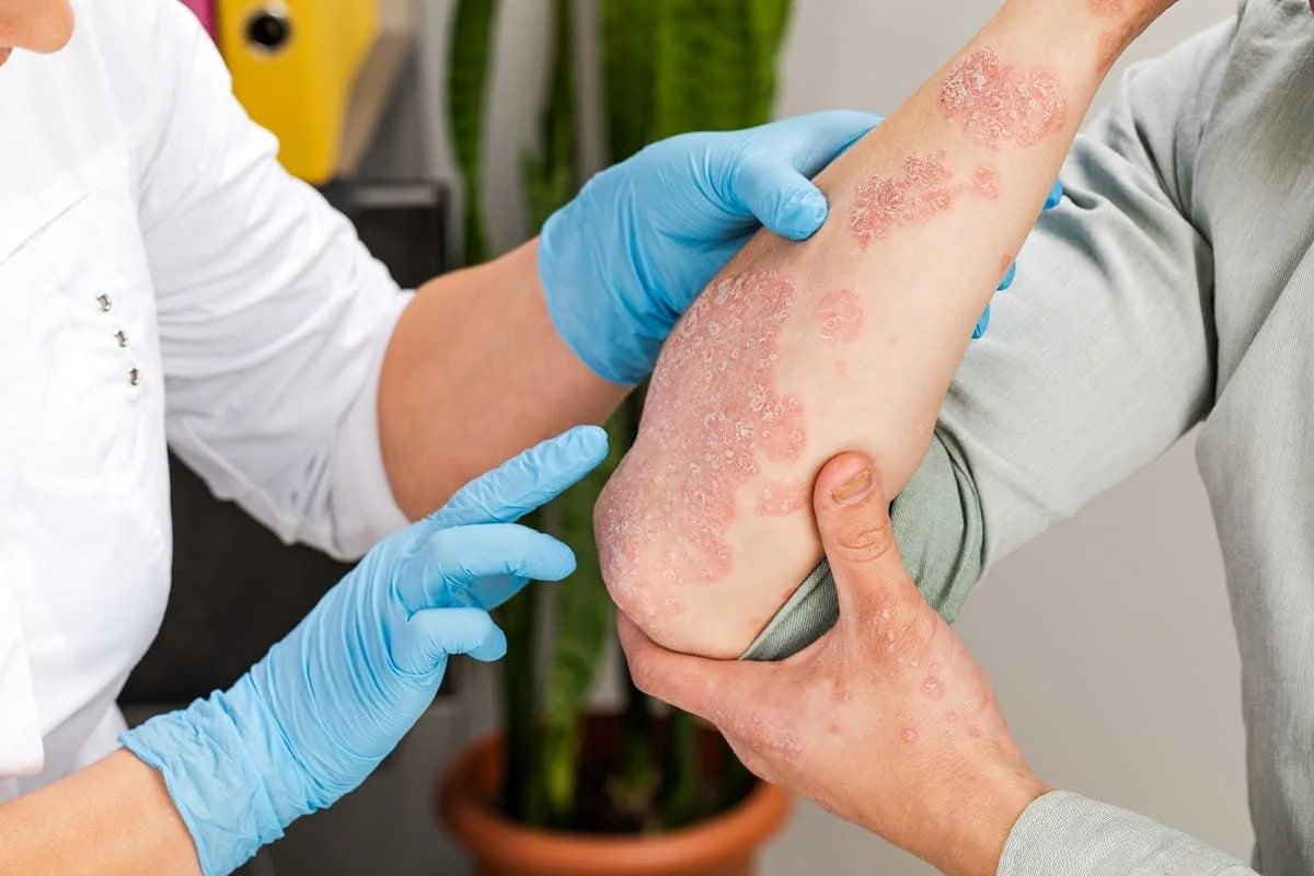 Psoriazis gutat: cauze, simptome, tratament