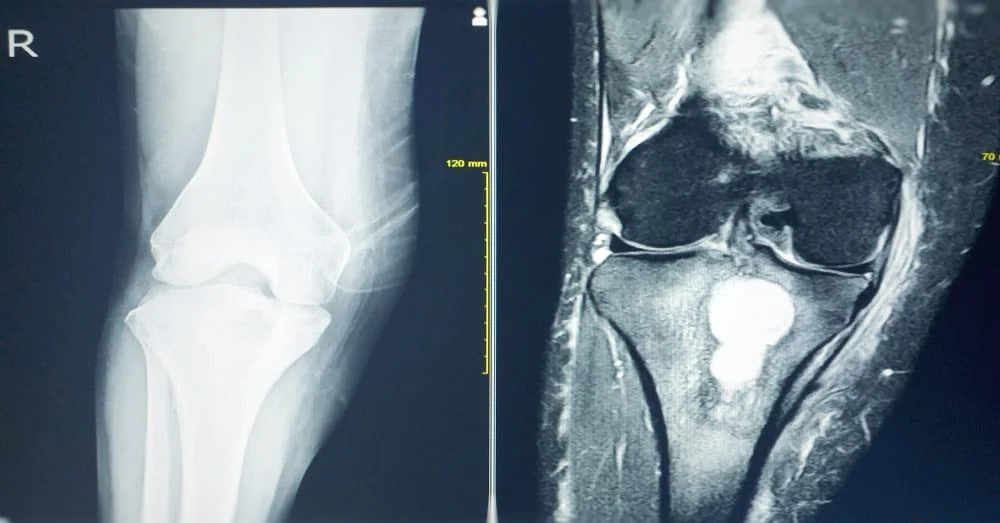 Osteoscleroza: cauze, simptome, tratament