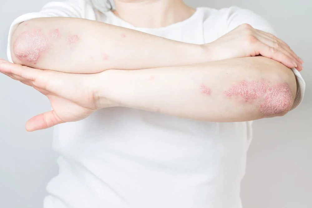 Artrita psoriazica: cauze, simptome, tratament