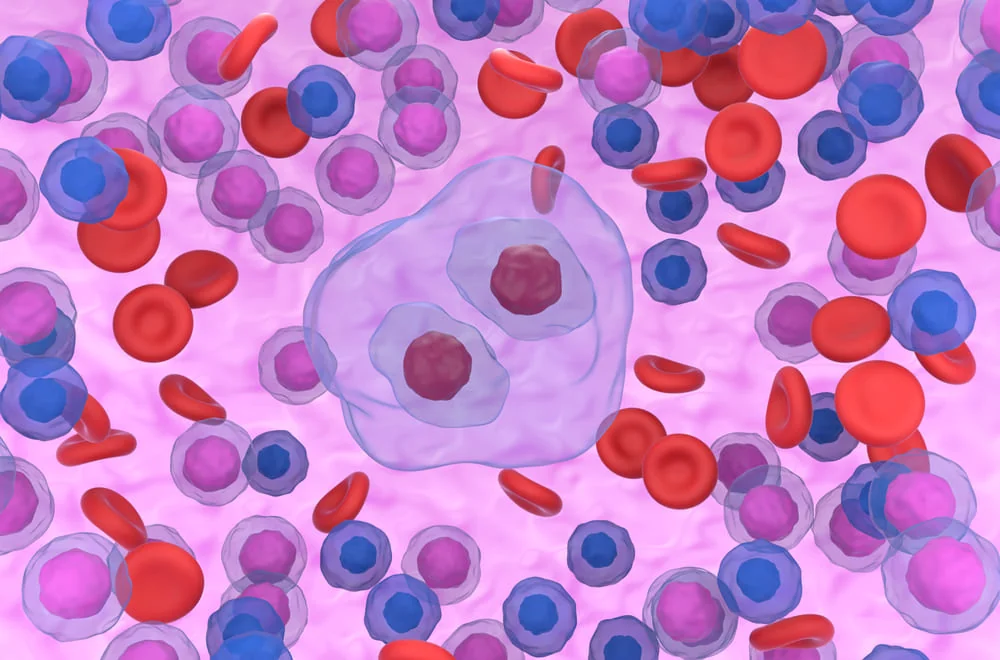 Stabilirea diagnosticului de limfom Hodgkin