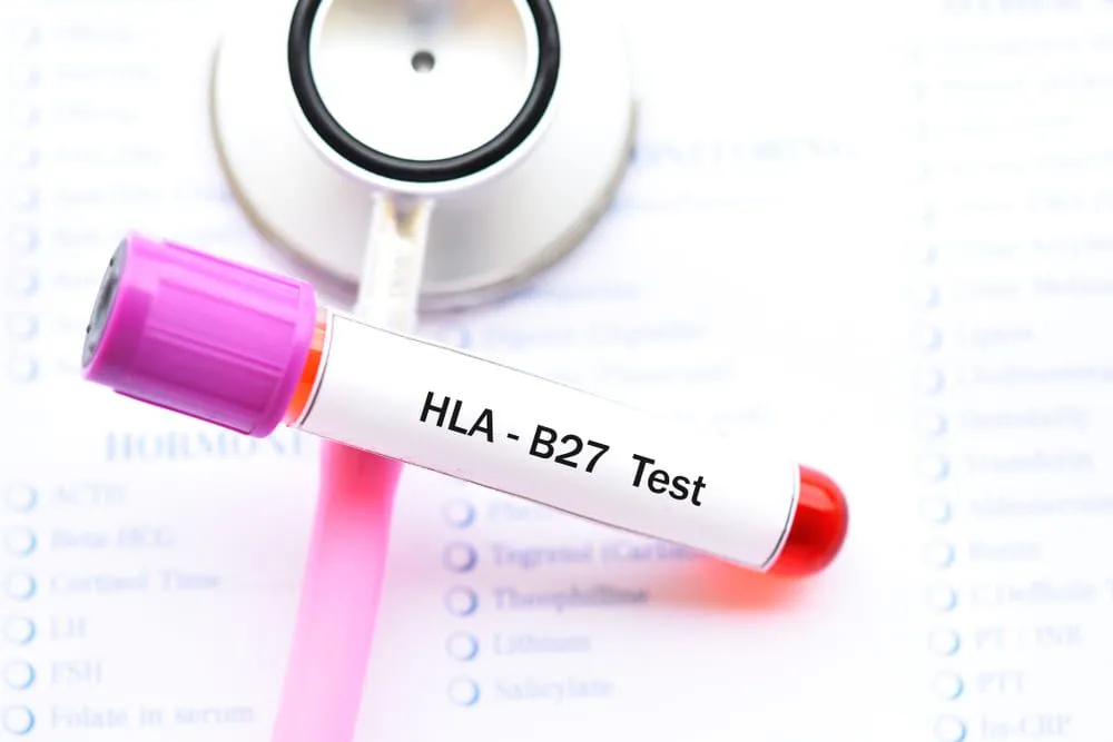 HLA B27: in ce consta si cand se recomanda aceasta analiza