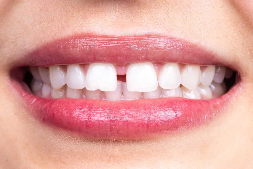 Strungareata (Diastema): tipuri, cauze, tratament