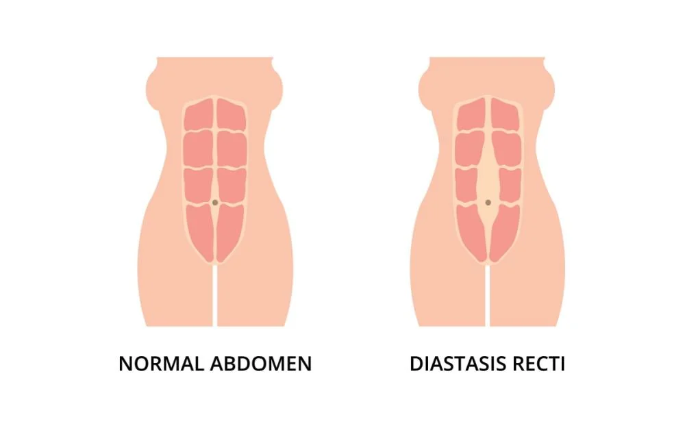 Diastaza abdominala: cauze, simptome, tratament