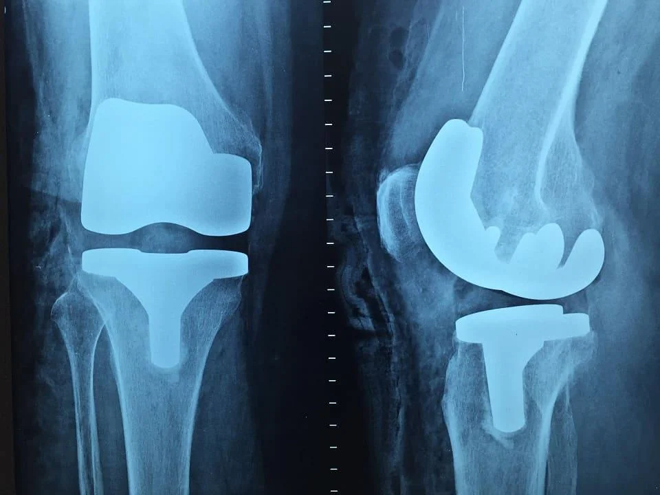 Fractura de femur: cauze, simptome si optiuni de tratament