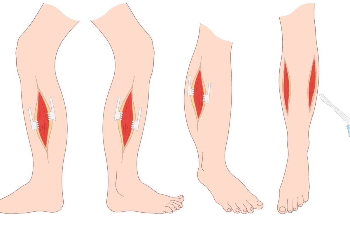 Fasciotomie: in ce consta, indicatii, contraindicatii