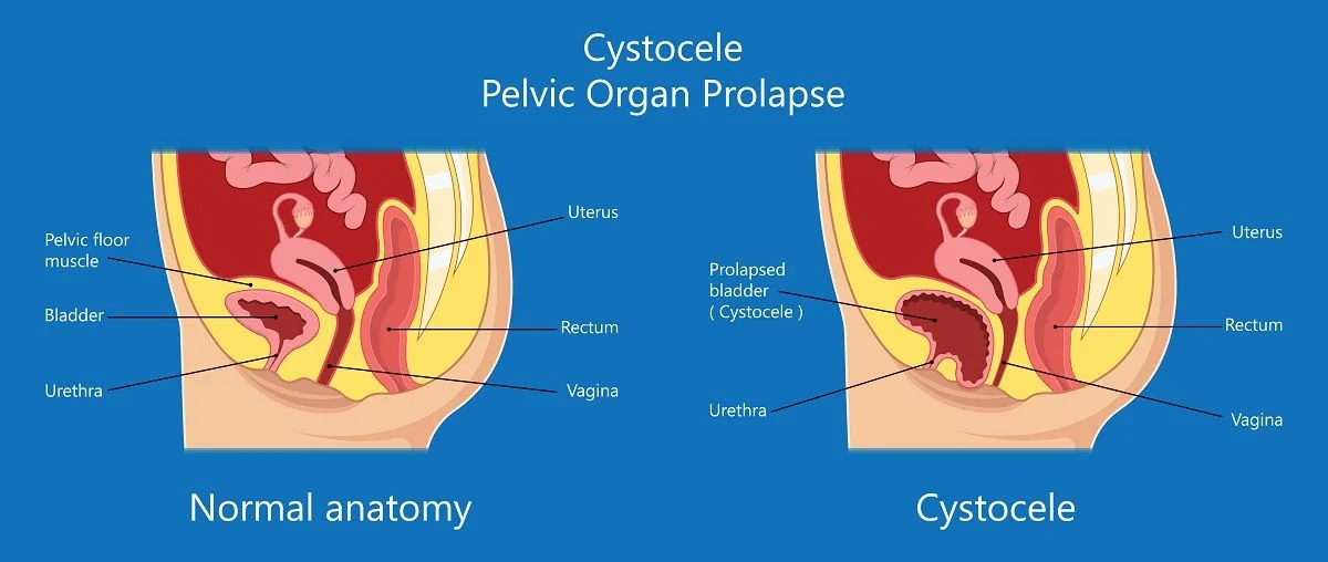 Cistocel: cauze, simptome, tratamen