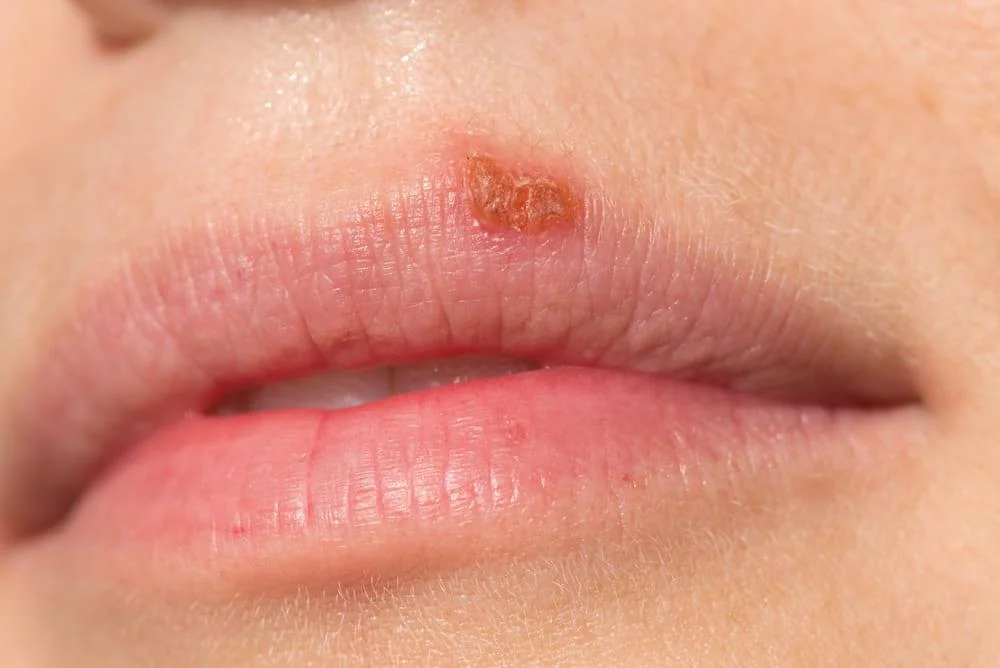 Herpes oral: cauze, simptome, tratament