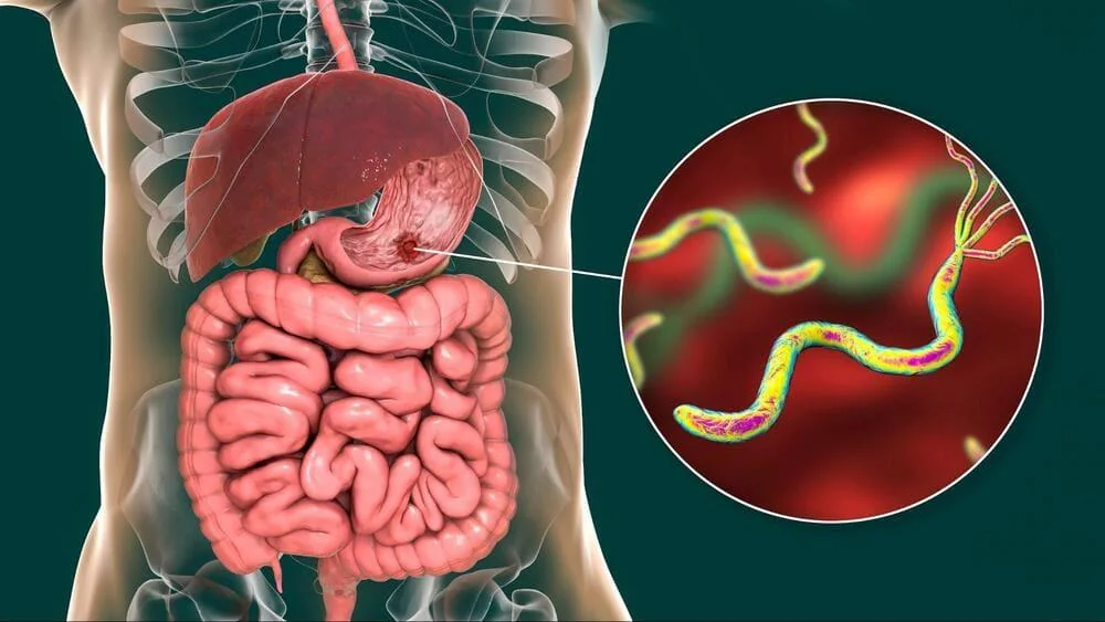 Ulcerul duodenal: cauze, simptome si optiuni de tratament