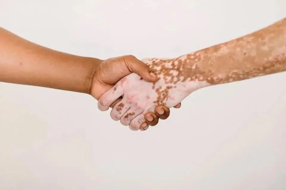 Vitiligo: cauze, simptome, tratament