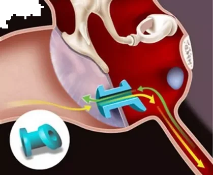 Tuburi de ventilatie a urechii la copii - Timpanotomia