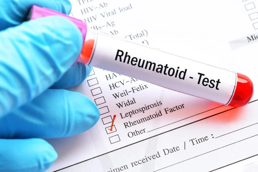 Factor reumatoid (FR): in ce consta si cand se recomanda aceasta analiza