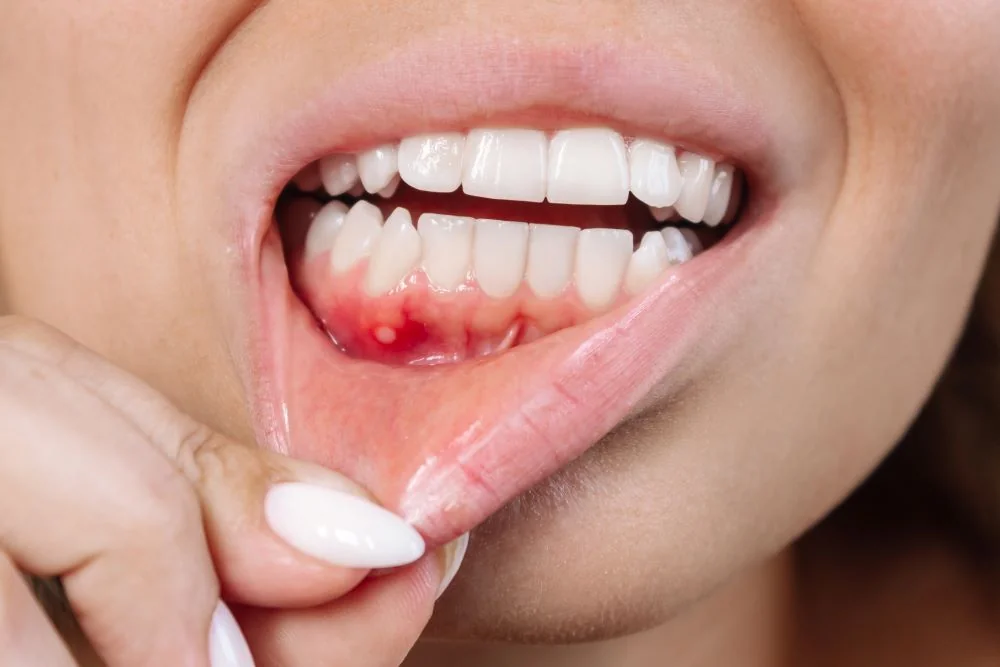 Gingivostomatita: cauze, simptome, tratament