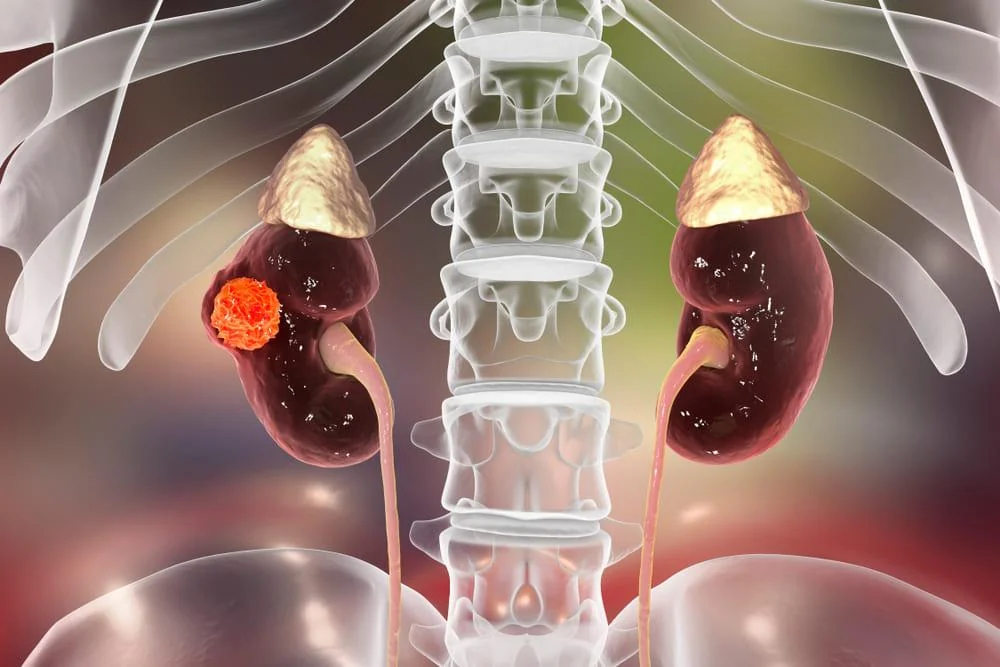 Cancerul renal: cauze, manifestari si optiuni de tratament 