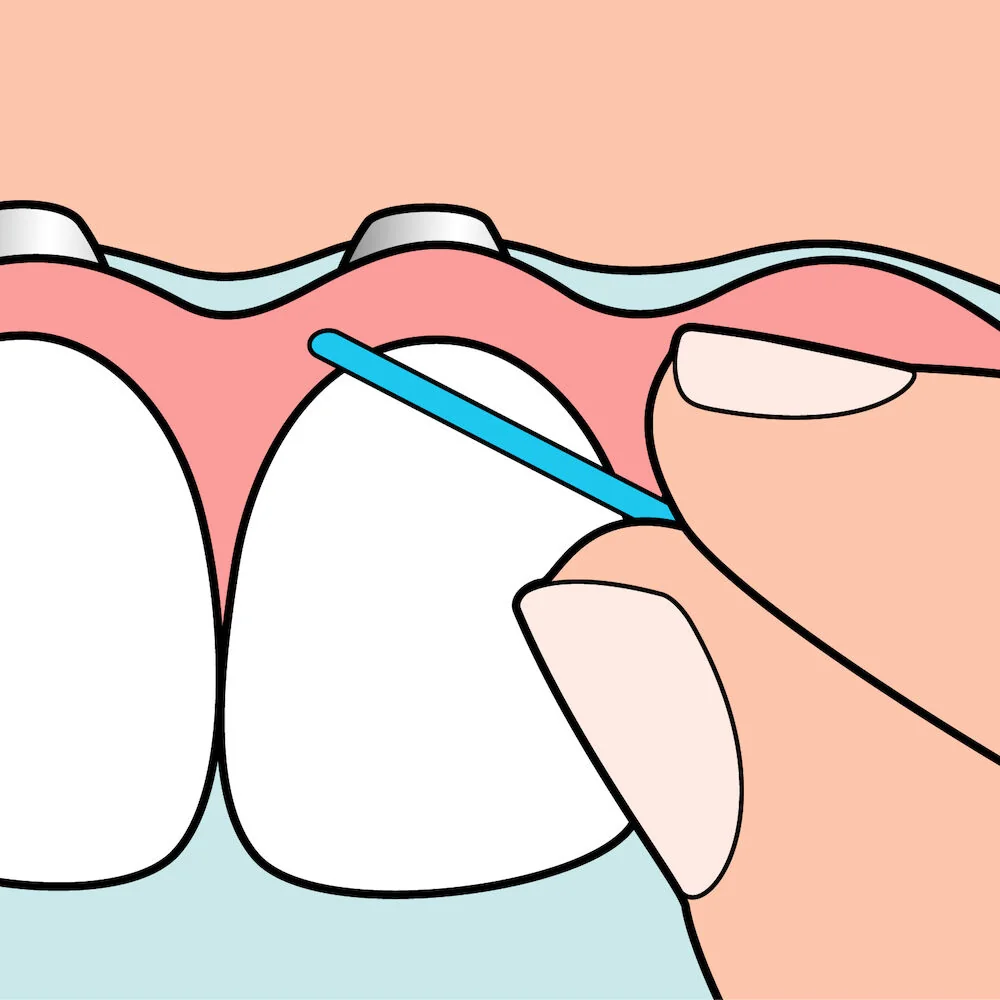 Ata detara pentru implanturi si lucrari Bridge&Implant Floss, 30 bucati, TePe 