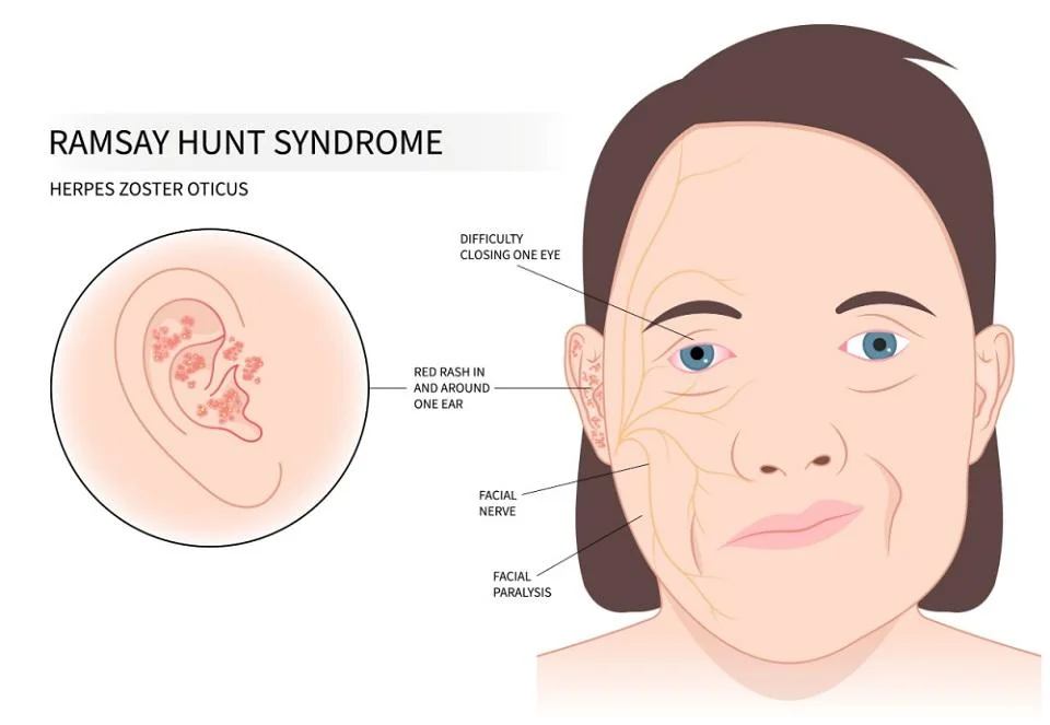 Sindromul Ramsay Hunt: cauze, simptome, tratament