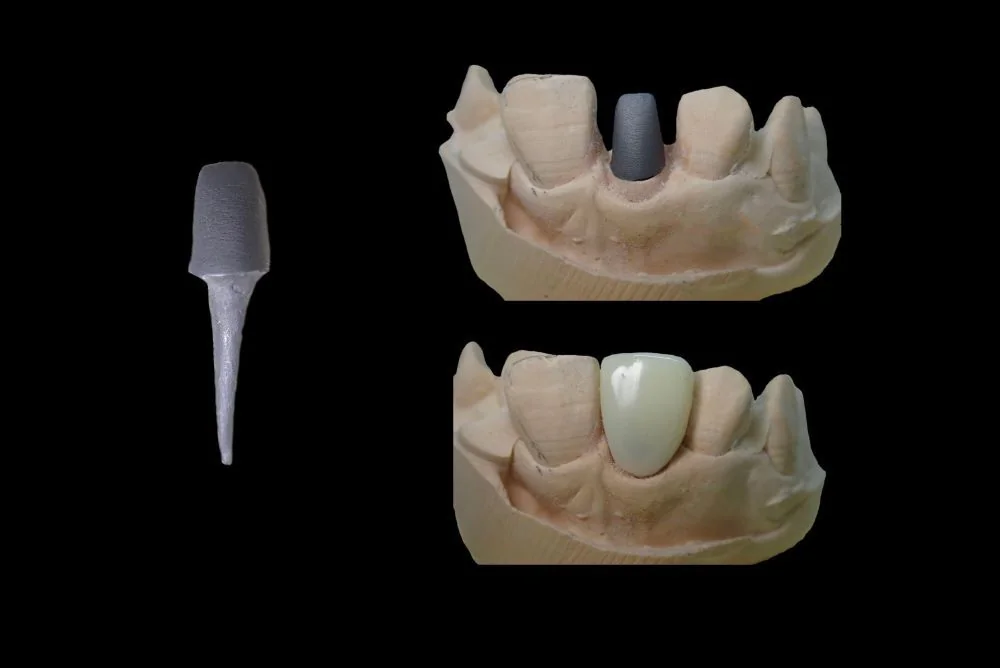 Pivot dentar: ce este, beneficii, contraindicatii