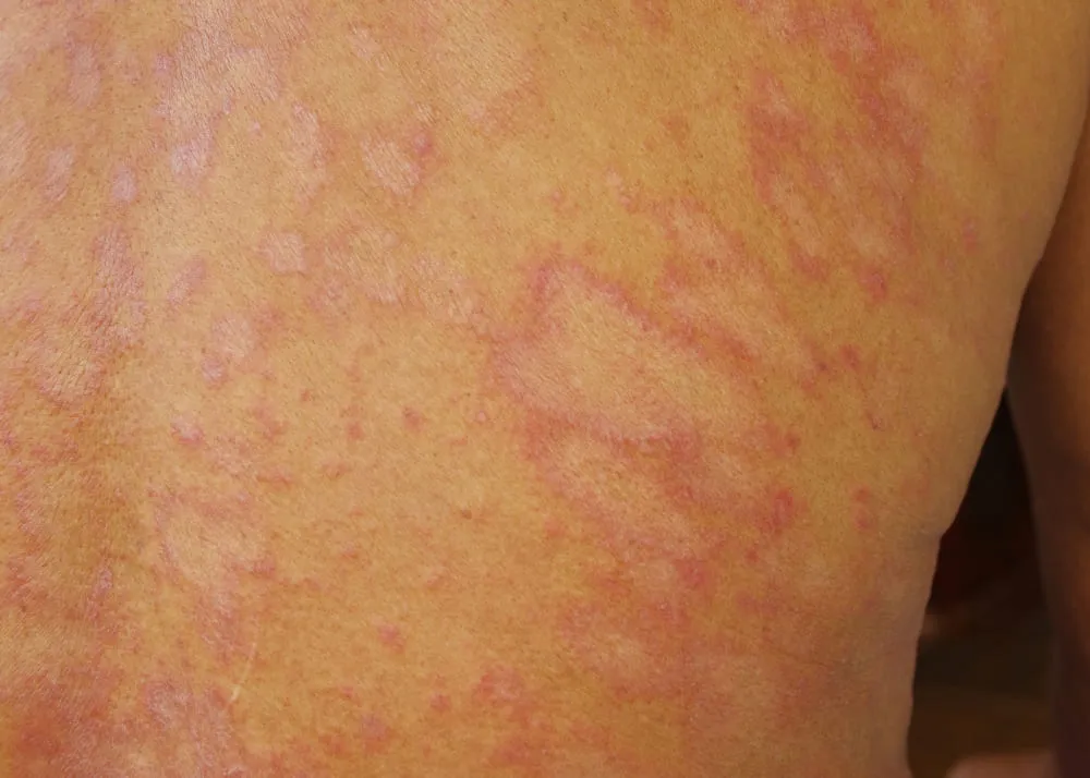 Dermatofitoza Tinea Corporis Cauze Simptome Tratament Drmax Farmacie 4737