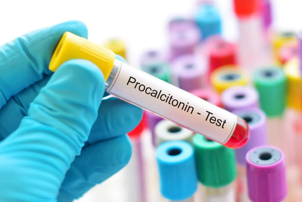 Procalcitonina: ce este, valori, afectiuni indicate