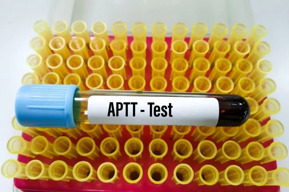 Timpul de tromboplastina partial activata (aPTT): tot ce trebuie sa stii