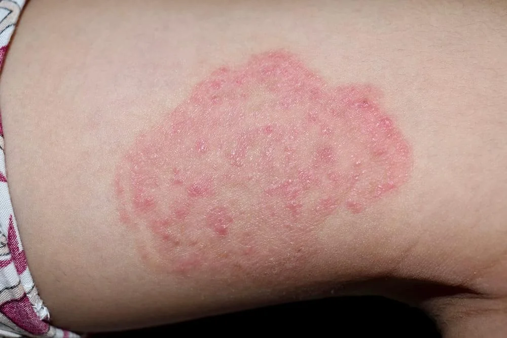 Dermatofitoza (Tinea Corporis): cauze, simptome, tratament