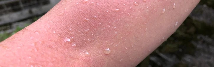 Urticaria acvagena: ce este alergia la apa, simptome si diagnostic
