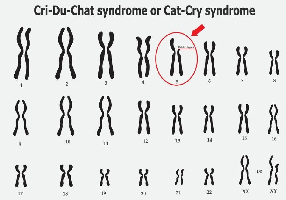 Sindromul Cri du chat: cauze, simptome, tratament