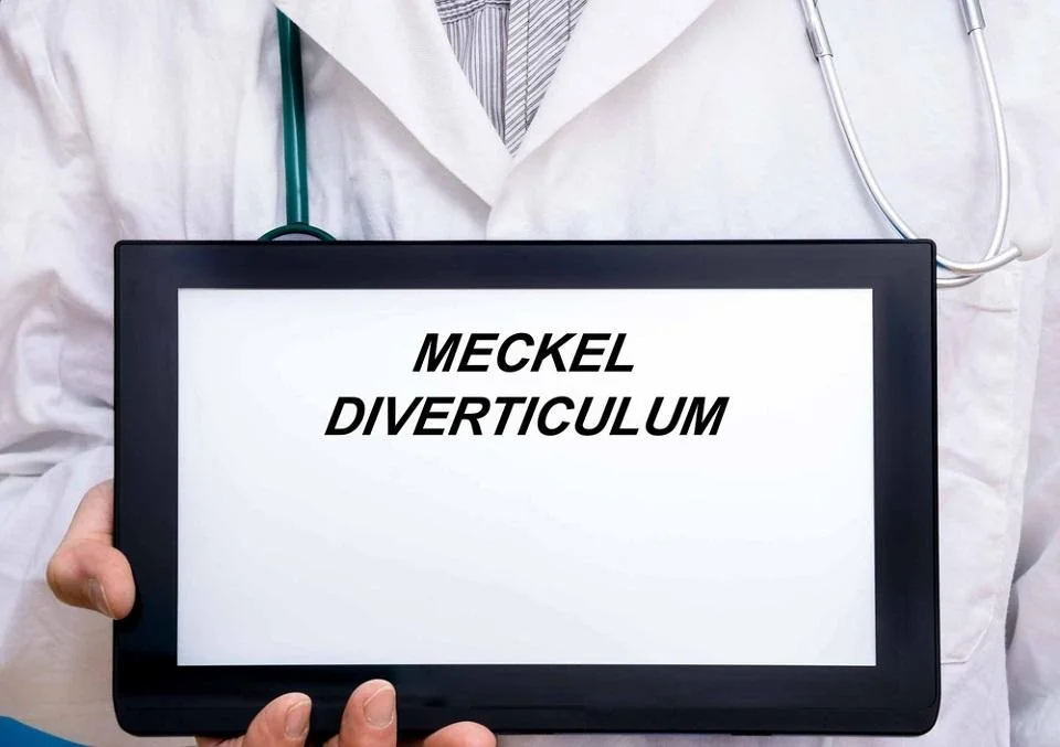 Diverticul Meckel: cauze, simptome, tratament