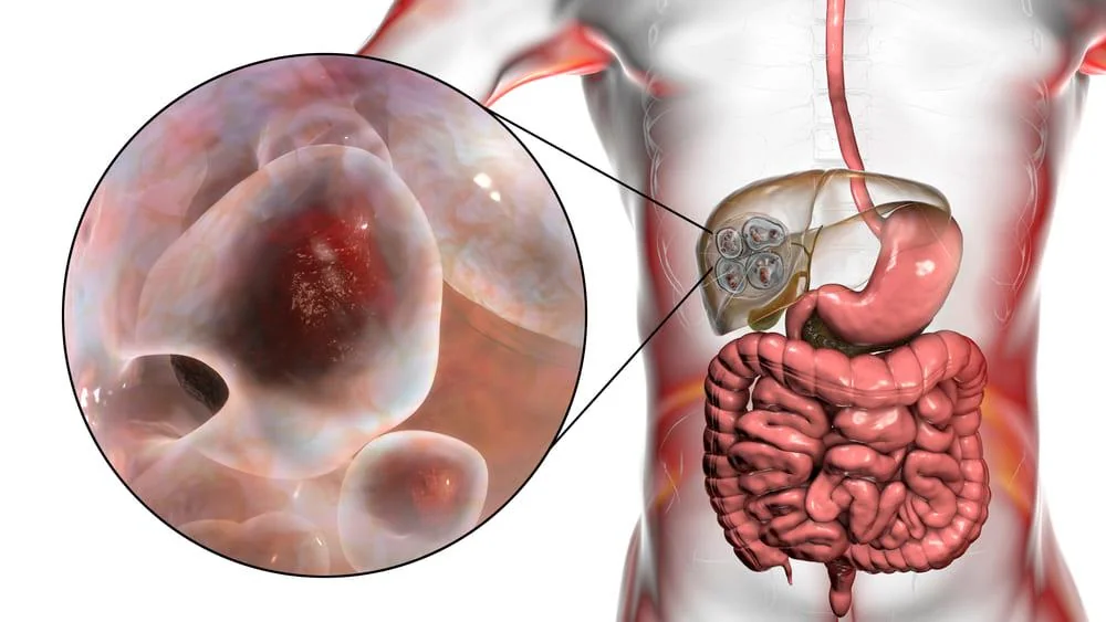 Chistul hidatic: cauze, manifestari si optiuni de tratament