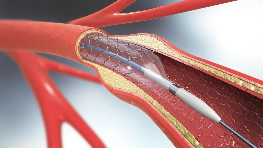 Stent: utilizare, beneficii, riscuri